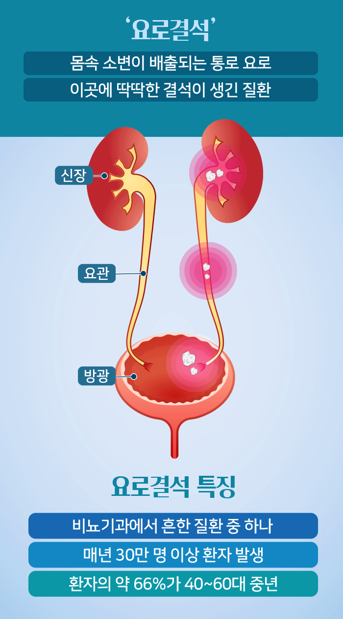 환자 2명 중 1명 재발하는 ‘요로결석’ 상태에 따른 치료 & 예방법 - 힐팁 환자 2명 중 1명 재발하는 ‘요로결석’ 상태에 따른 치료 & 예방법