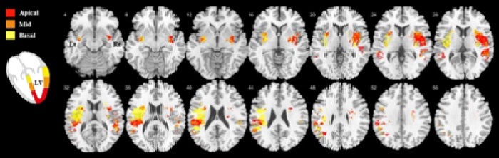 좌심실을 세 부위로 나눠서 분석했을 때 좌심실 움직임 변화에 이상이 생긴 곳에 따라 뇌의 손상 영역도 조금씩 달랐던 것을 확인할 수 있다. 해당 영역에 뇌졸중이 발생하면 좌심실의 각 부위도 영향을 받는다는 의미다. 빨간색(정점), 주황색, 노란색(기저부)으로 구분. [이미지 삼성서울병원]